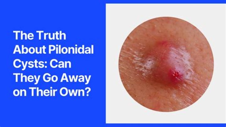 Can girls get pilonidal cyst