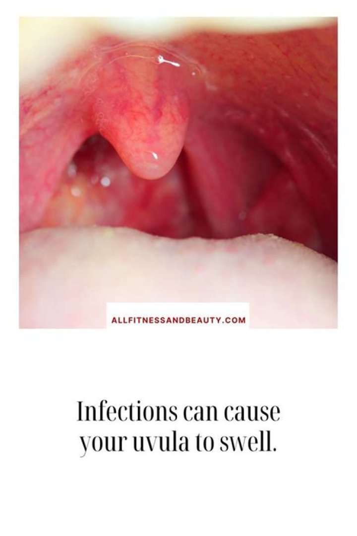 Can snoring cause a swollen uvula