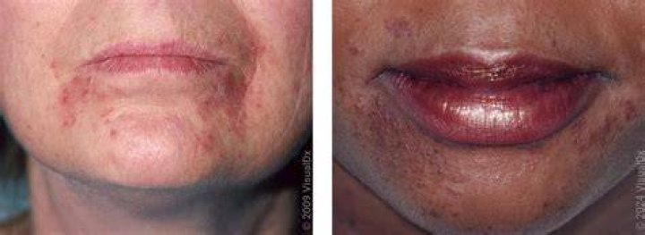 Does perioral dermatitis look like acne