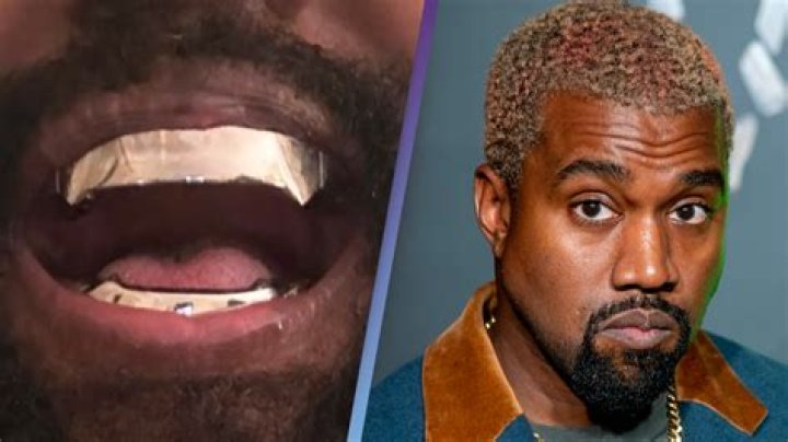 How much did Kanye West teeth cost