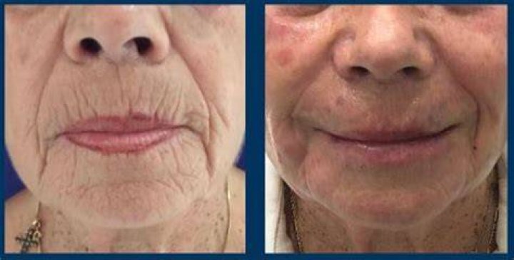 hyaluronic acid injection face