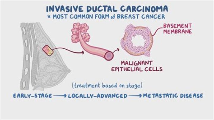 Is invasive lobular carcinoma aggressive