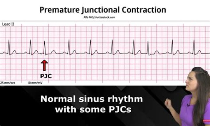 Pjc Ecg - How To Discuss