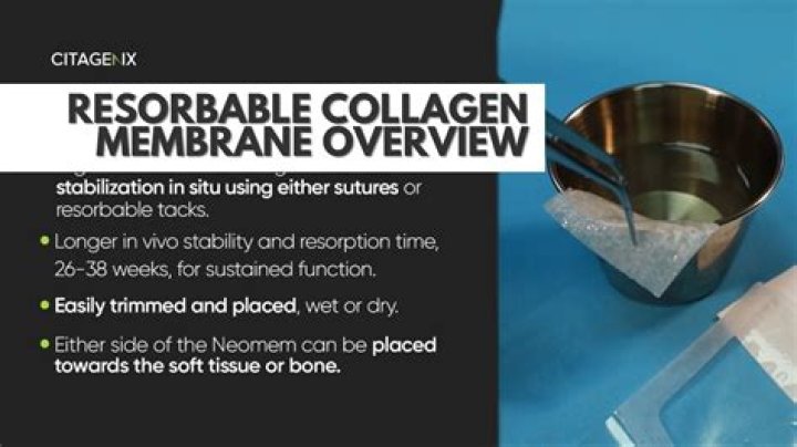 Resorbable Membrane Fell Out - How To Discuss