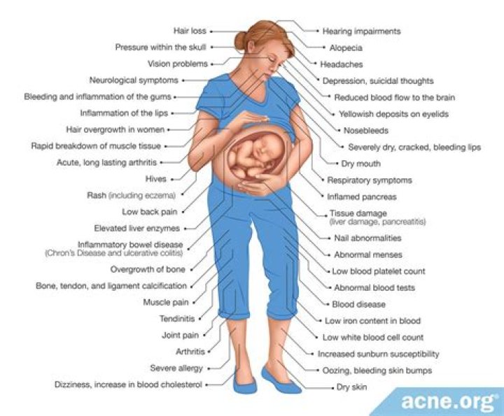 What birth defects are caused by Accutane