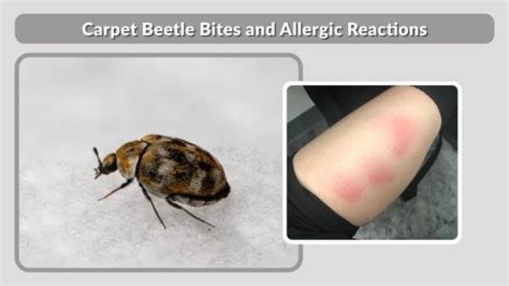 What can I put on carpet beetle bites