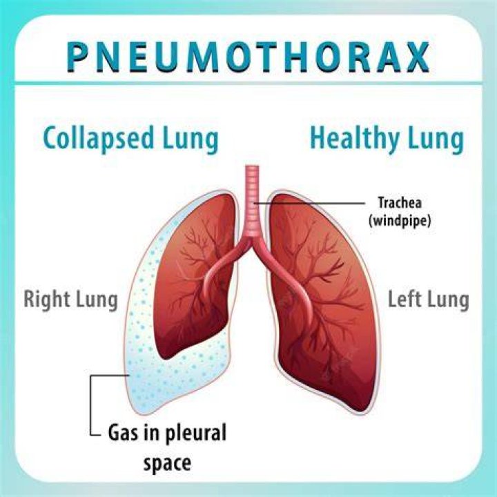 What causes a simple pneumothorax