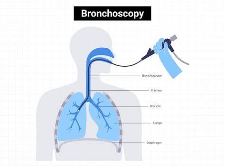 What is a bronchoscopy with washing