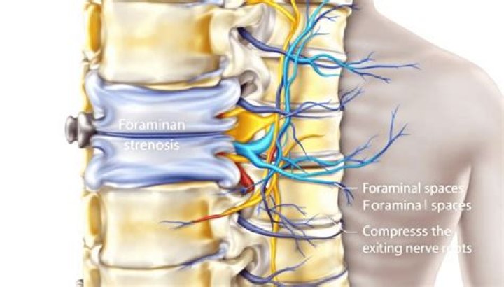 What is the ICD 10 code for neural Foraminal stenosis
